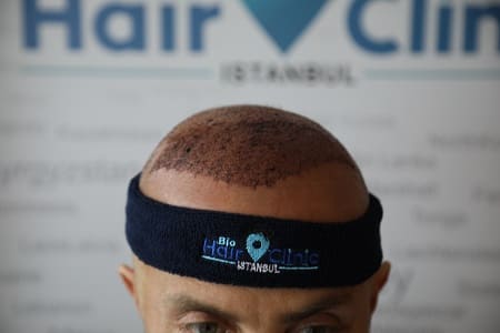 Eigenhaartransplantation bei Haarausfall - Stirnband mit Bio Hair Clinic Logo