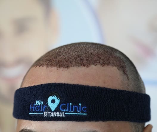 Haartransplantation mit Mega-FUE bei Bio Hair Clinic Haartransplantation mit Mega-FUE