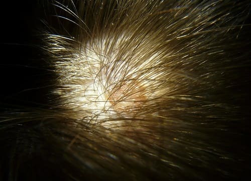 Kopfhautpilz ist aufgrund von starkem, sichtbarem Haarausfall.