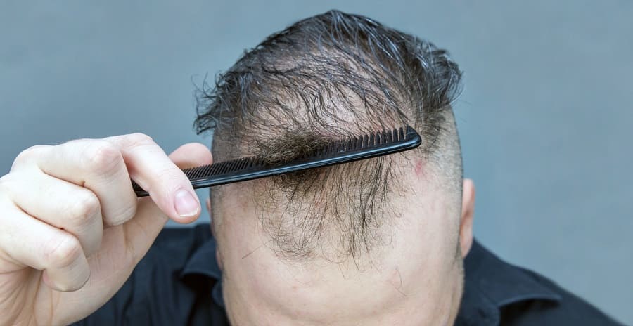 Kopfhauterkrankungen mit Haarausfall