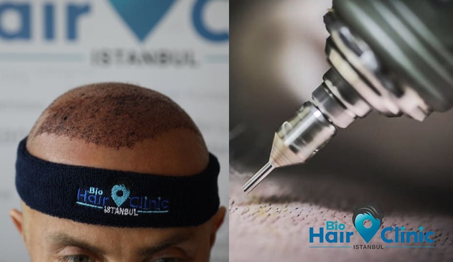 Hohlnadel Haartransplantation - FUE Methode bei Eigenhaarverpflanzung