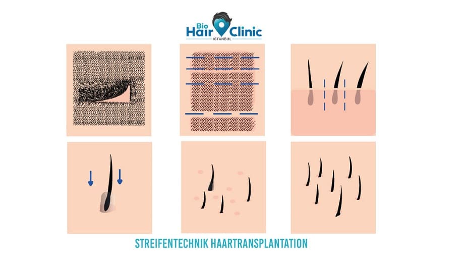 Streifentechnik Haartransplantation - Bio Hair Clinic