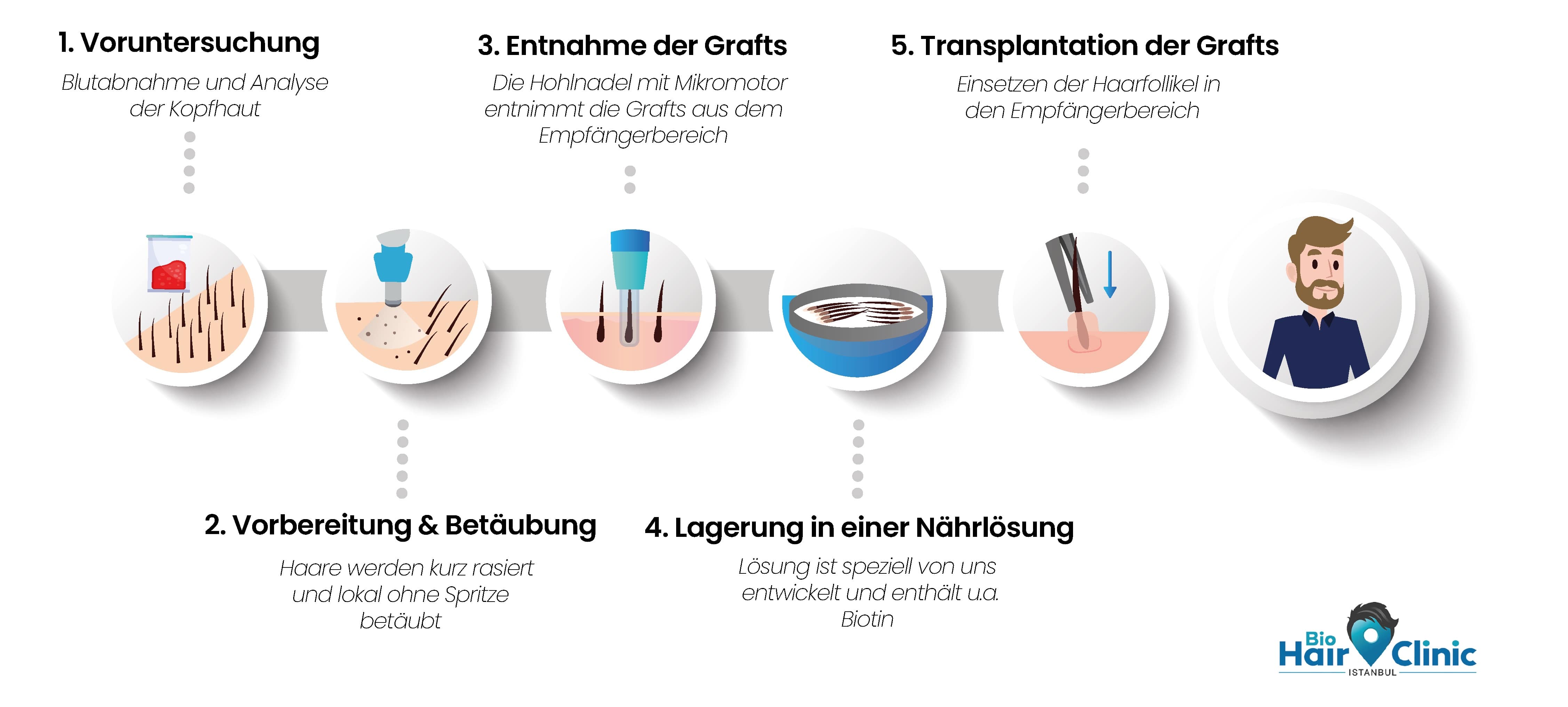 Die Moderne Haartransplantation Fue Methode Alle Informationen