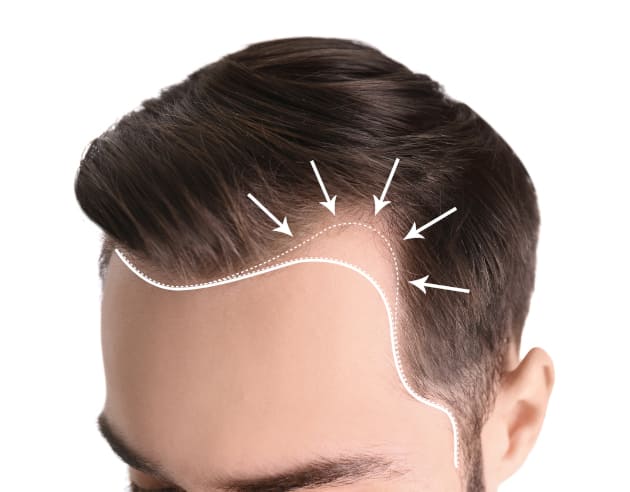 Unnatüriche Haarlinie eines Patienten Unnatuerliche Haarlinie bei einem Mann mit aufgezeichnetem Korrekturvorschlag auf der Stirn