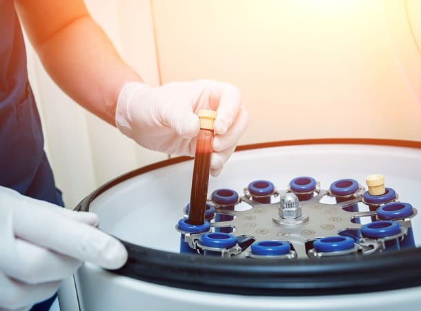 Bei der PRP Behandlung zentrifugiert der Arzt Blut.