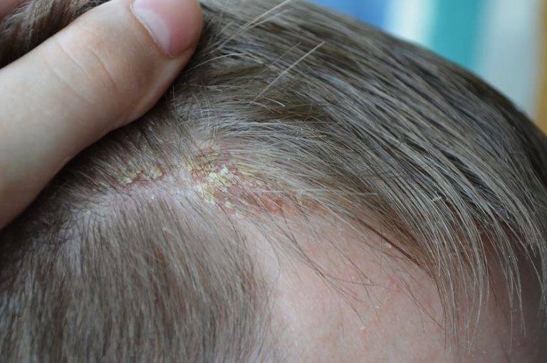 Diffuser Haarausfall Wie lässt sich der Haarschwund aufhalten?
