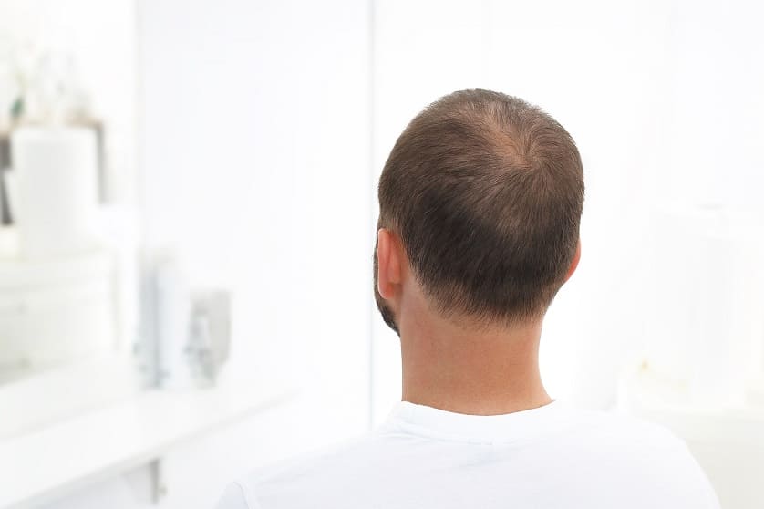 Mann mit Haarausfall wird von hinten fotografiert