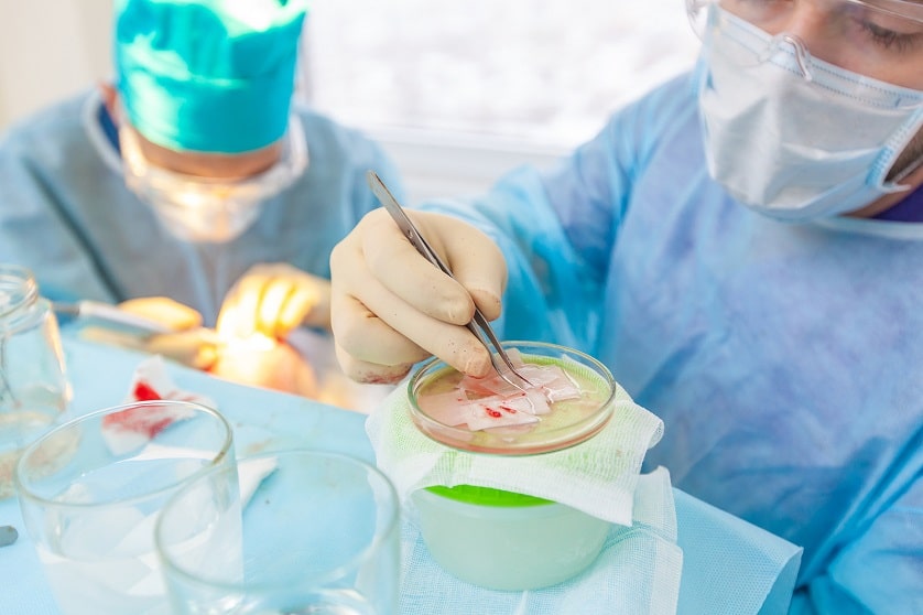 Ärzte im Behandlungsraum führen eine Haartransplantation durch und selektieren die Haarfollikel in einer Petrischale