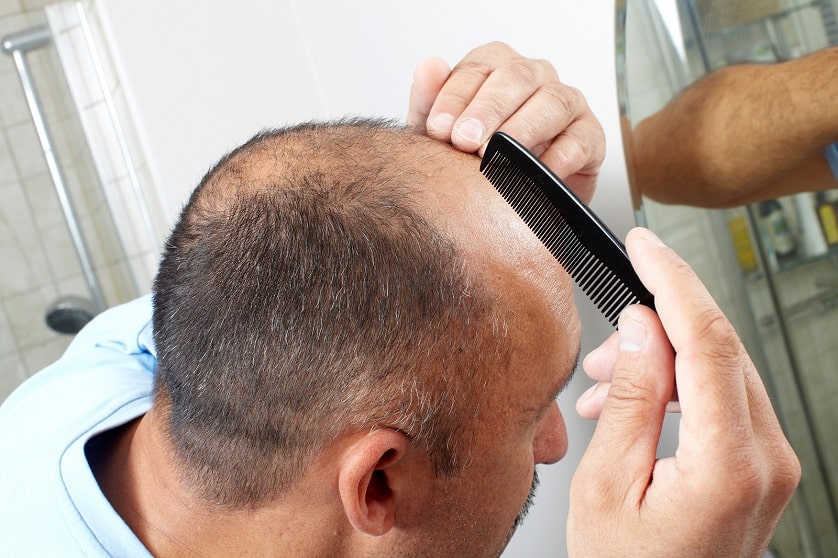 Mann mit erblich bedingtem Haarausfall
