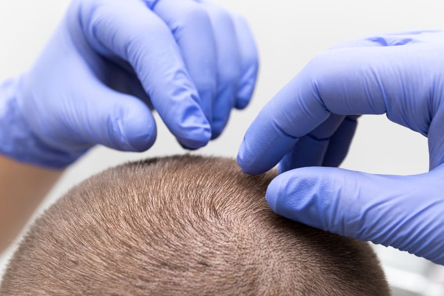 Arzt untersucht nach der Haartransplantation ob Pickel entstanden sind