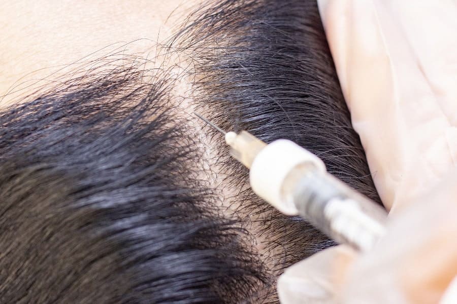 PRP Behandlung Alternative zur Haartransplantation, Alter unabhängig.