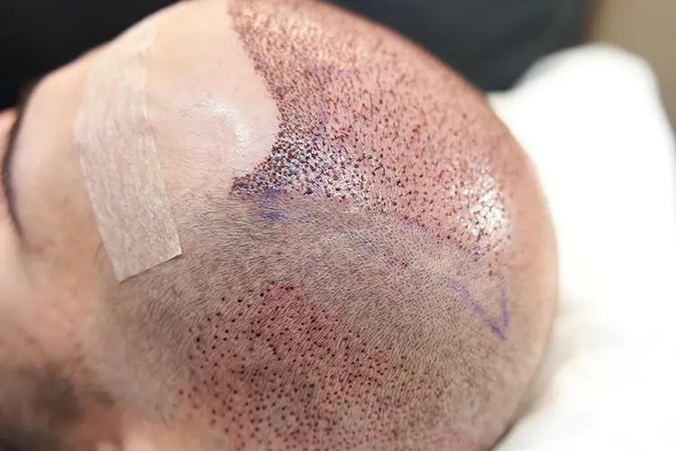 Der Kopf eines Mannes nach einer Haartransplantation. Die einzelnen Einstiche der Grafts sind zu sehen