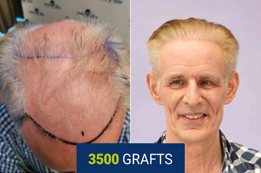 Vorher Nachher Vergleich nach einer Haartransplantation mit der DHI Technik, 3500 Graft bei Andreas Löschke