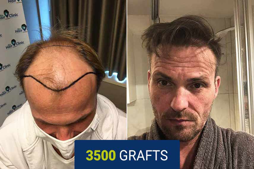 Vorher Nachher Vergleich nach einer Haartransplantation mit der DHI Technik, 3500 Graft bei Martin Brust