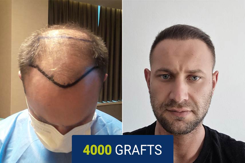 Vorher Nachher Vergleich nach einer Haartransplantation mit der DHI Technik, 4000 Graft bei Raul Andre Lazea