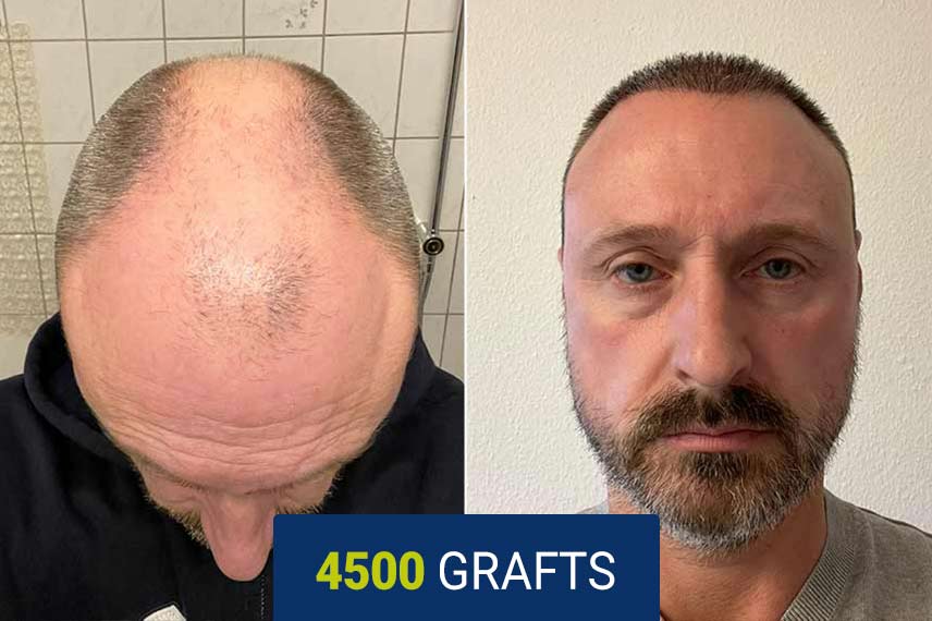 Vorher Nachher Vergleich nach einer Haartransplantation mit der DHI Technik, 4500 Graft beI Markus Alexander Lambertz