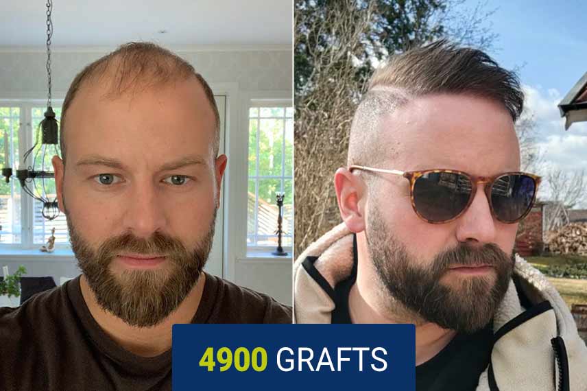 Vorher Nachher Vergleich nach einer Haartransplantation mit der DHI Technik, 4900 Graft beI Josef Gustavsson