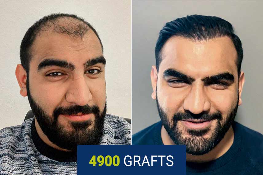 Vorher Nachher Vergleich nach einer Haartransplantation mit der DHI Technik, 4900 Graft bei Osman