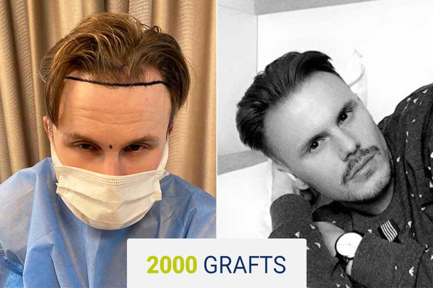 Vorher Nachher Vergleich nach einer Haartransplantation mit der Saphir Technik, 2000 Graft bei Ilja Firauf