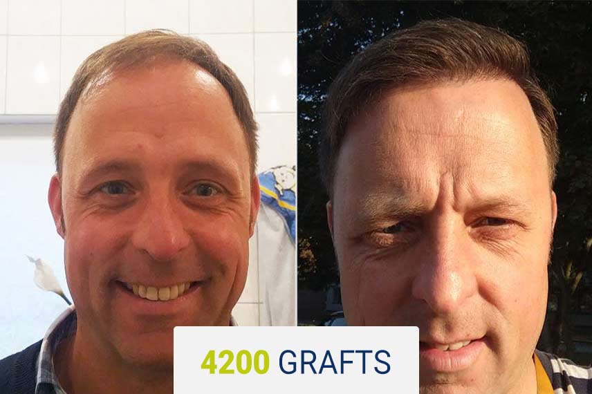 Vorher Nachher Vergleich nach einer Haartransplantation mit der Saphir Technik, 4200 Graft bei Andreas Laupus