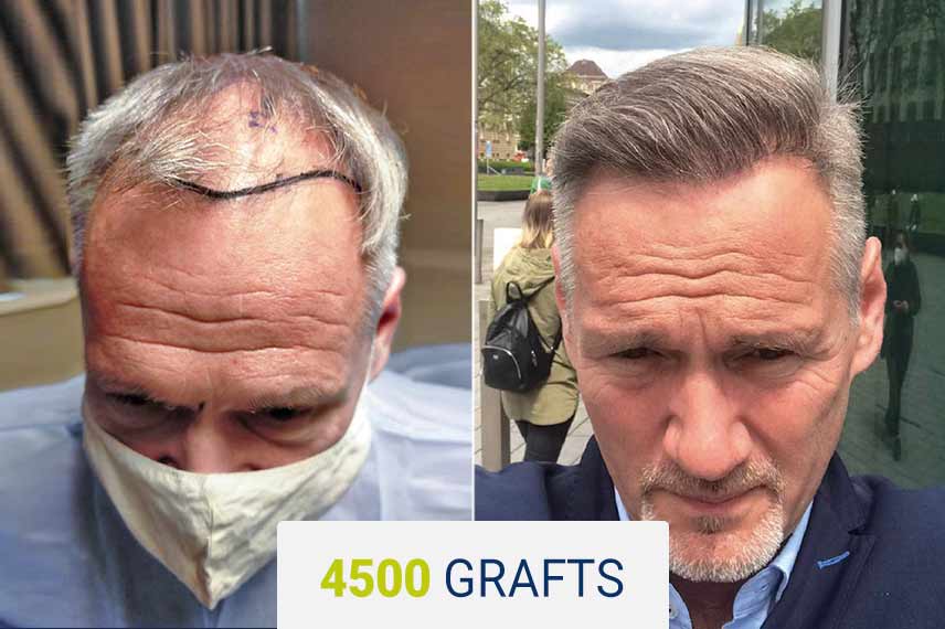 Vorher Nachher Vergleich nach einer Haartransplantation mit der Saphir Technik, 4500 Graft bei Ruediger Nurkowski-Bürkle