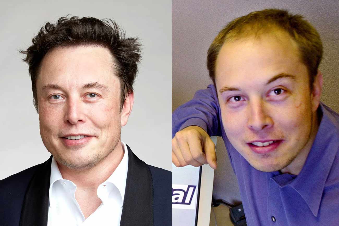 Elon Musk Haartransplantation Vorher Nachher