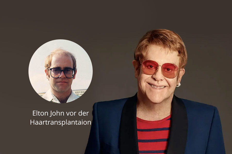 Elton John vor und nachdem er seine Haare transplantiert hat