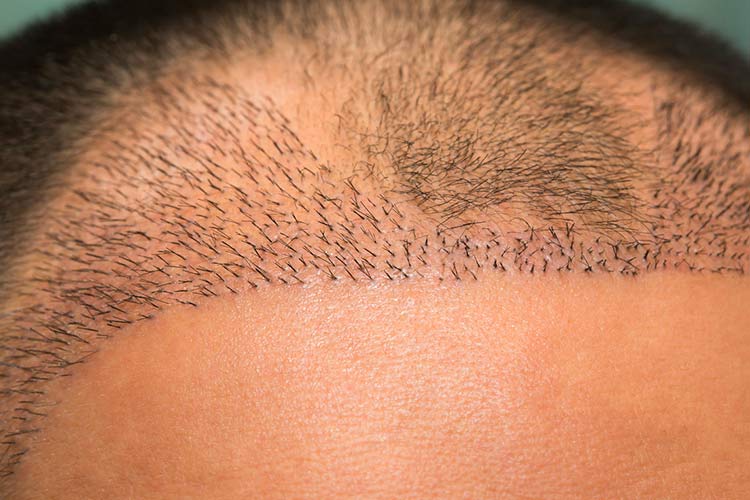 Aufgefüllte und verheilte Geheimratsecken nach einer Haartransplantation