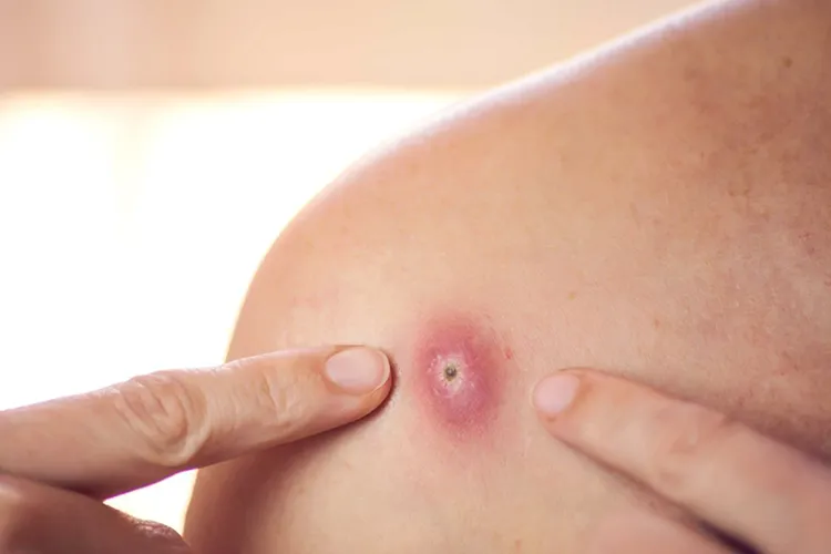Finger zeigt auf Haarwurzelentzündung.