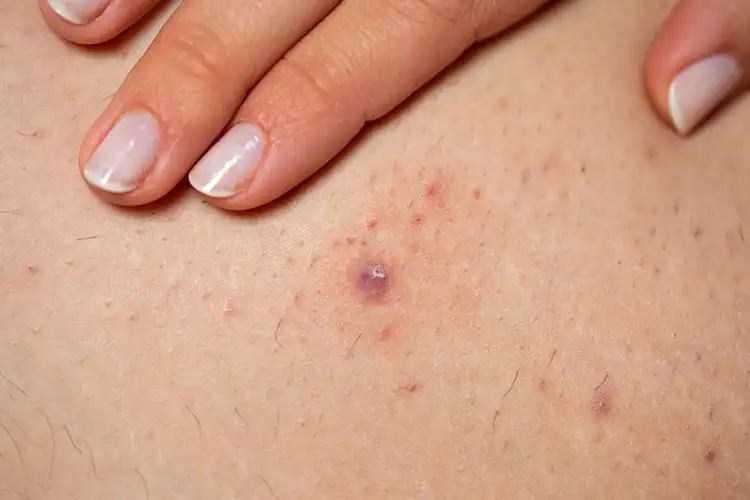 Eine leicht entzündete Haarwurzel auf der Haut. Die Stelle ist gerötet und geschwollen. Über der Entzündung liegt die Hand einer Frau.